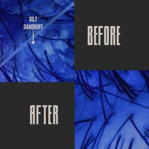 Microscopic scalp comparison: before image shows oily dandruff buildup around hair follicles; after image shows clean, healthy scalp.