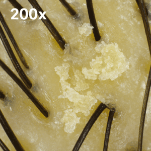 Microscopic image of human scalp at 200x magnification showing oily buildup, clogged follicles, and signs of oily dandruff, used to illustrate scalp health concerns.